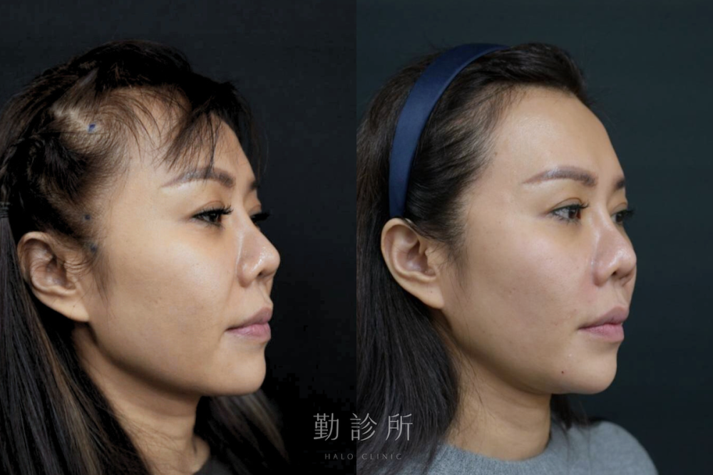 勤診所｜跨層次迴繞拉提案例：中臉拉提改善法令紋 右臉