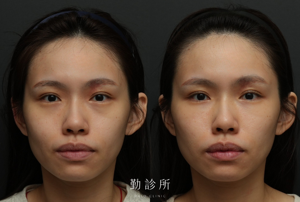 勤診所｜三層式淚溝隱形案例： 正面