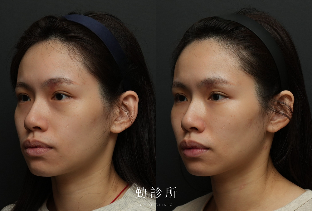 勤診所｜三層式淚溝隱形案例： 左臉