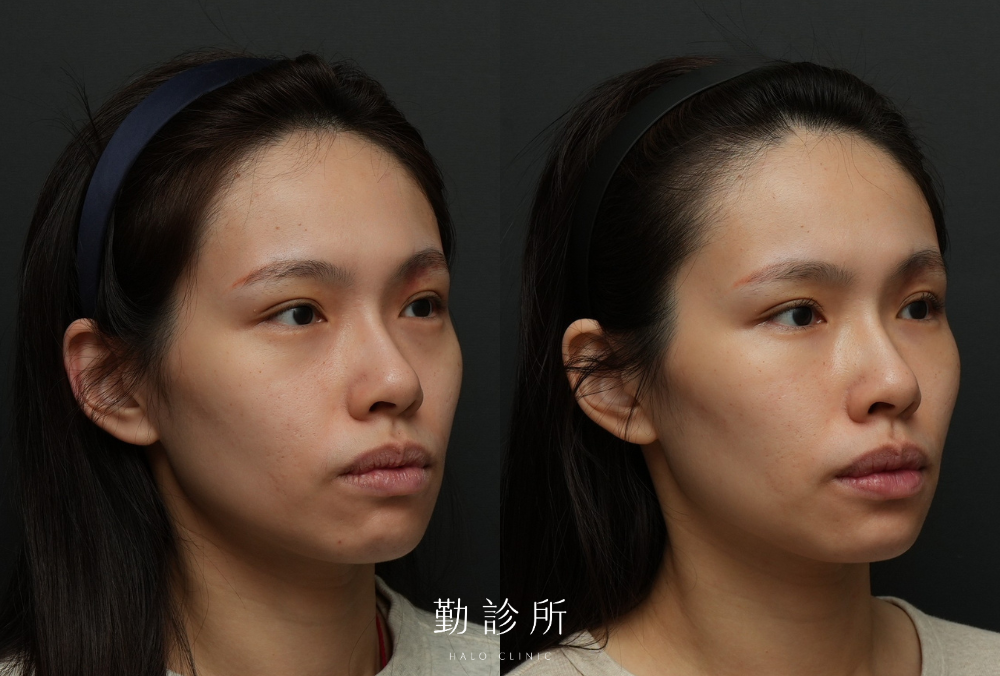 勤診所｜三層式淚溝隱形案例： 右臉