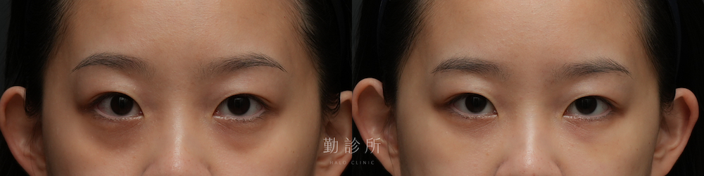 勤診所｜三層式淚溝隱形案例：正面