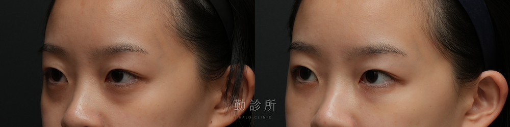 勤診所｜三層式淚溝隱形案例：左臉