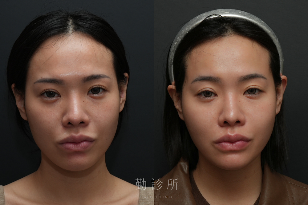 勤診所｜跨層次迴繞拉提案例：中臉拉提 改善法令、清晰輪廓線 正面