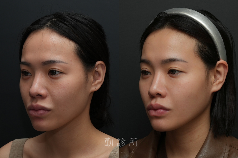 勤診所｜跨層次迴繞拉提案例：中臉拉提 改善法令、清晰輪廓線 左臉