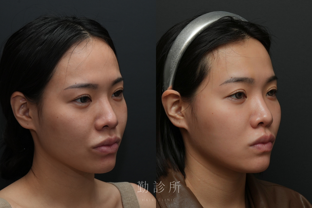 勤診所｜跨層次迴繞拉提案例：中臉拉提 改善法令、清晰輪廓線 右臉