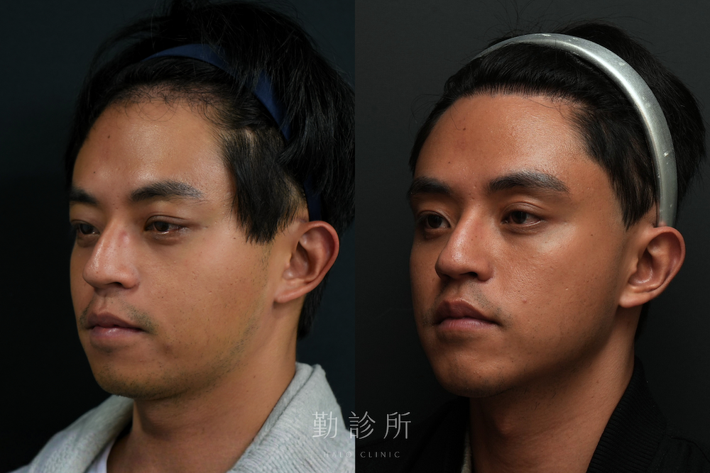 勤診所｜全臉臉規劃案例：三層式淚溝＋Vivacy 下巴輪廓線＋Ellanse 眉骨提升 左臉