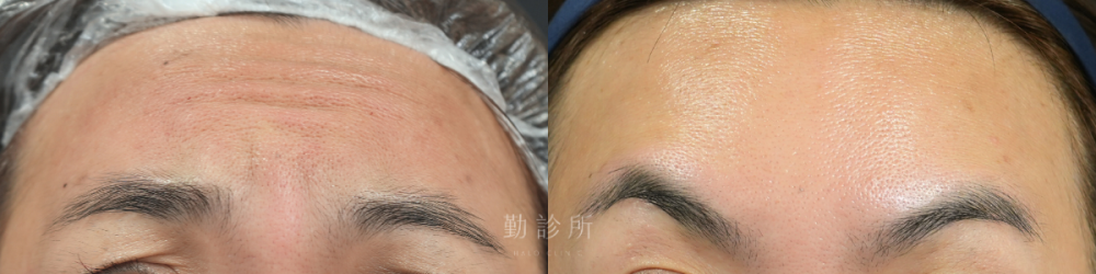 勤診所｜肉毒注射真實案例：肉毒除皺抬頭紋 正面