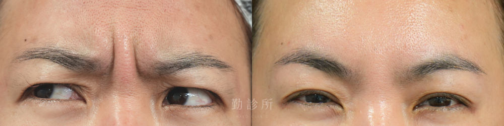 勤診所｜肉毒注射真實案例：肉毒除皺眉 正面