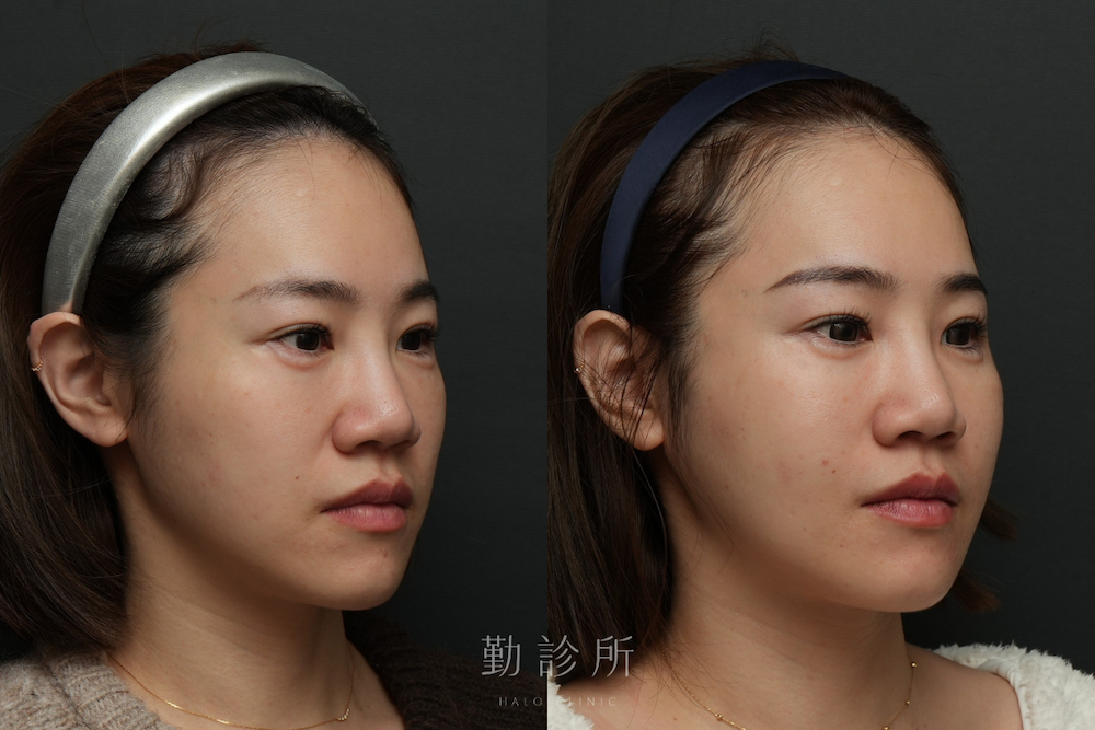 勤診所｜鳳凰電波案例：紫鑽探頭全臉 + 跨層次迴繞拉提 右臉