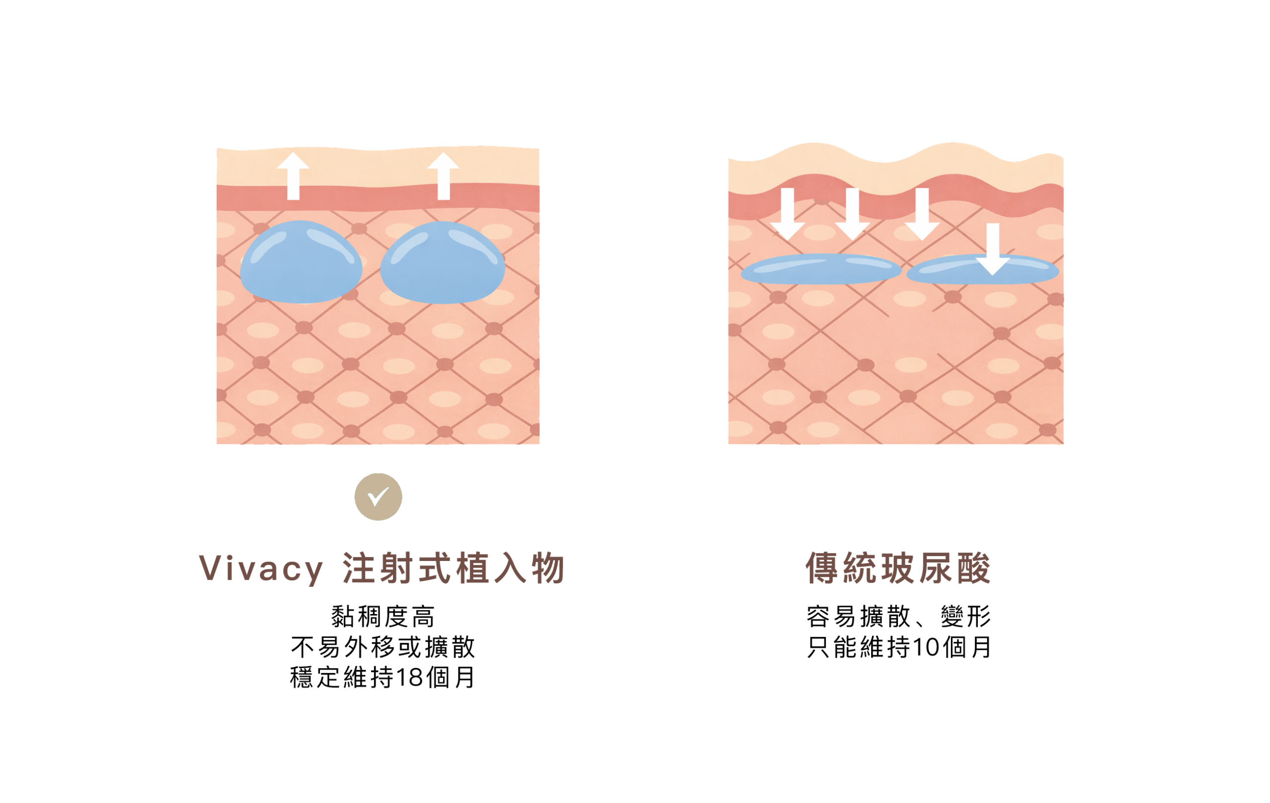 勤診所｜維法熙玻尿酸 專利加持第三代玻尿酸打破寬鼻魔咒