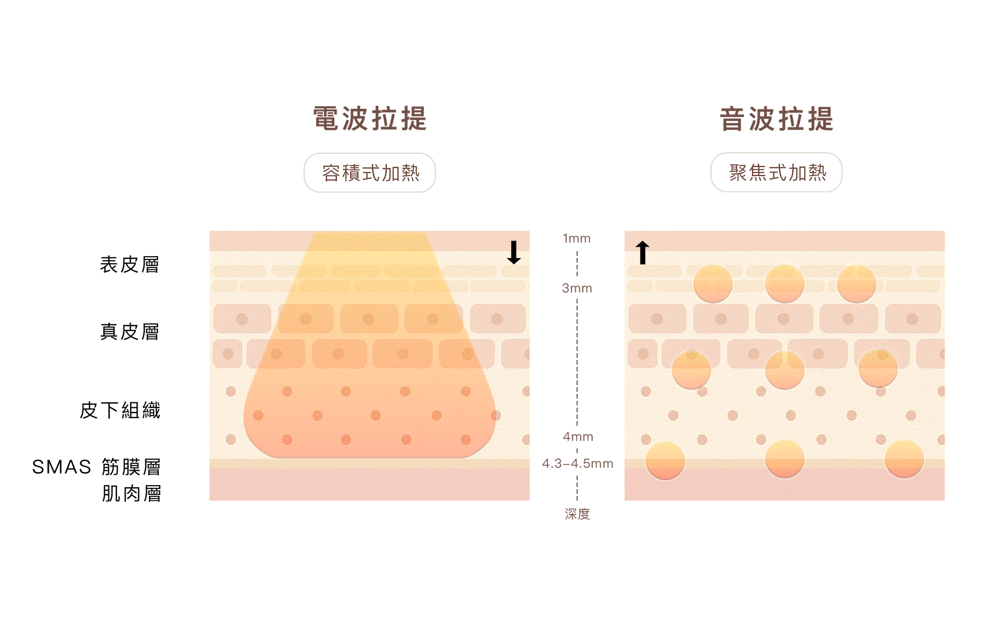 勤診所｜海芙音波vs鳳凰電波哪個好?