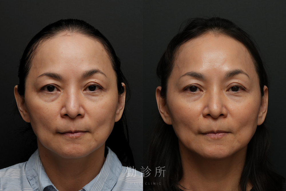 勤診所｜鳳凰電波案例：紫鑽探頭 900發全臉規劃 + 碧眼探頭 2 顆雙眼緊緻 正面