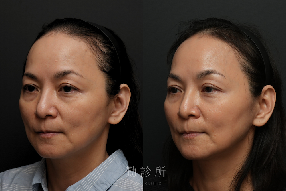 勤診所｜鳳凰電波案例：紫鑽探頭 900發全臉規劃 + 碧眼探頭 2 顆雙眼緊緻 左臉