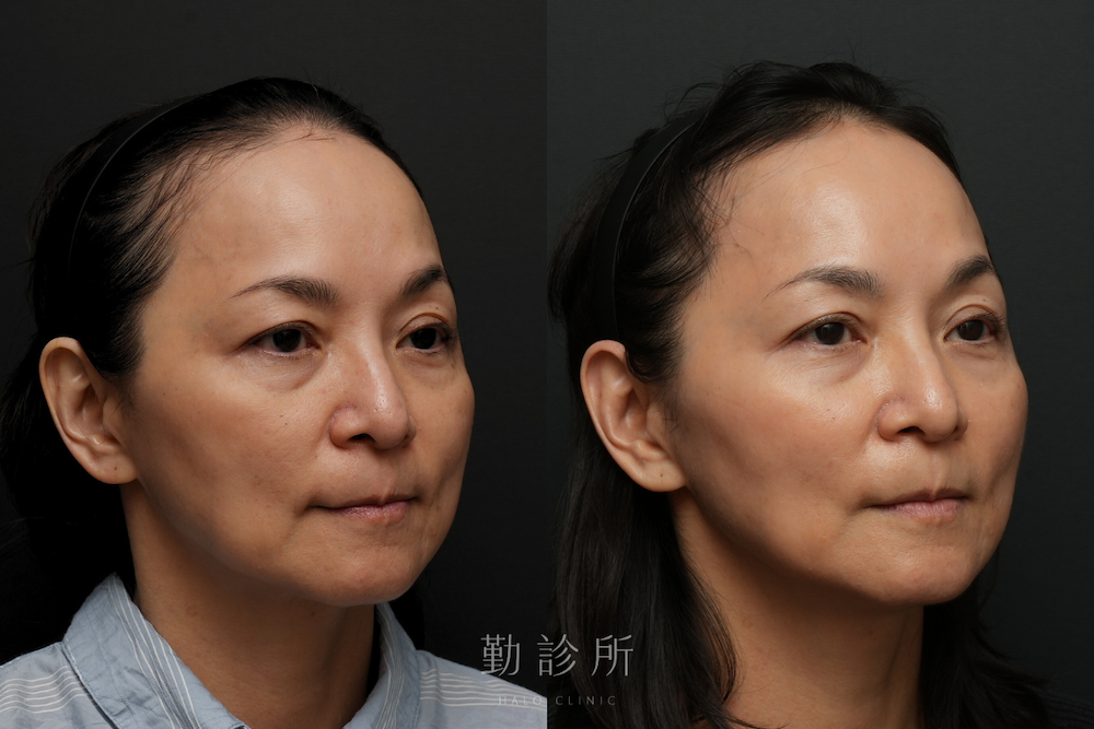 勤診所｜鳳凰電波案例：紫鑽探頭 900發全臉規劃 + 碧眼探頭 2 顆雙眼緊緻 右臉