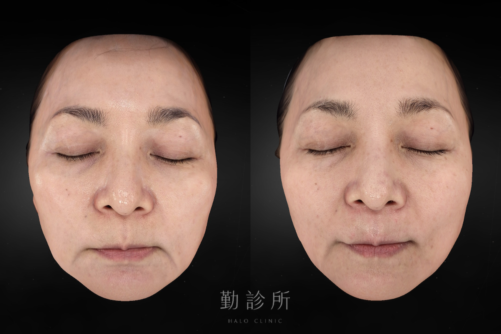 勤診所｜鳳凰電波案例：紫鑽探頭 900發全臉規劃 + 碧眼探頭 2 顆雙眼緊緻 正面 （皮膚檢測視圖）