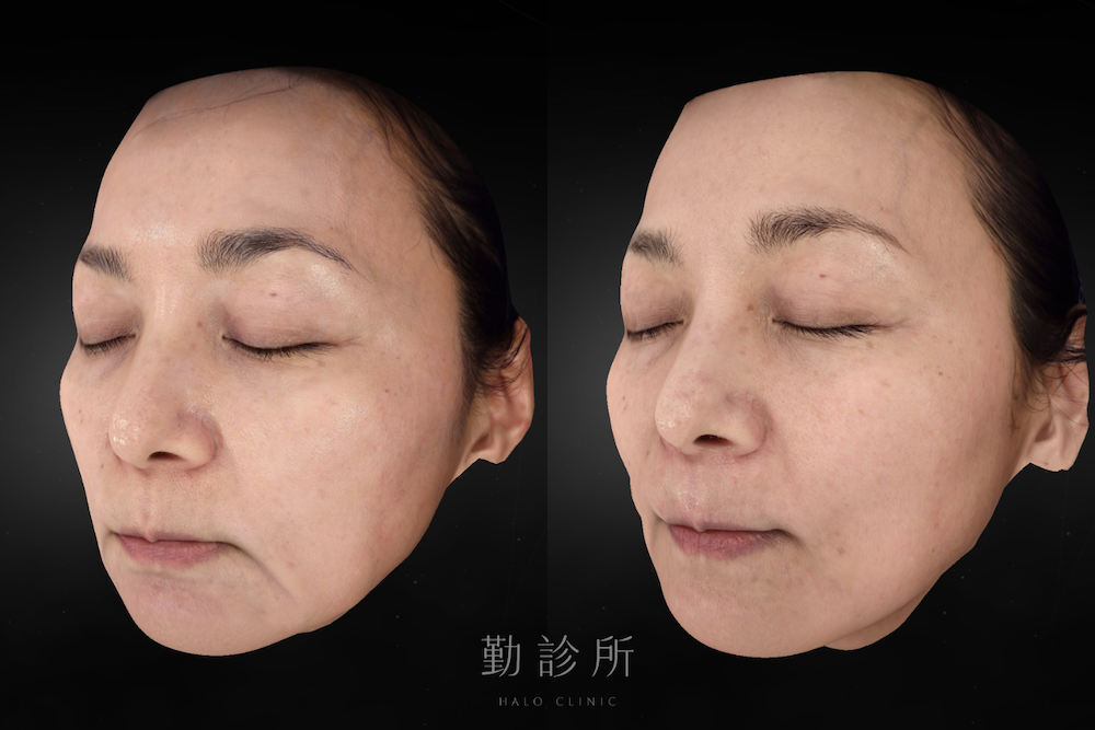 勤診所｜鳳凰電波案例：紫鑽探頭 900發全臉規劃 + 碧眼探頭 2 顆雙眼緊緻 左臉 （皮膚檢測視圖）