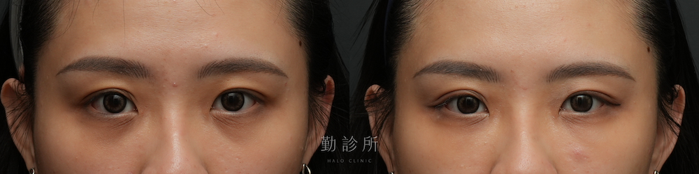 勤診所｜三層式淚溝隱形案例： 正面