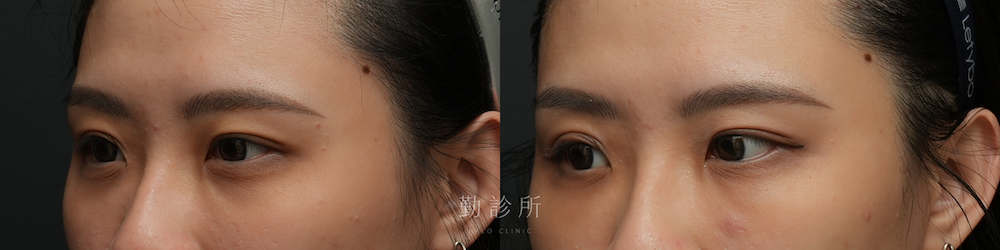 勤診所｜三層式淚溝隱形案例： 左臉