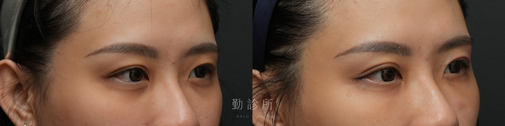 勤診所｜三層式淚溝隱形案例： 右臉