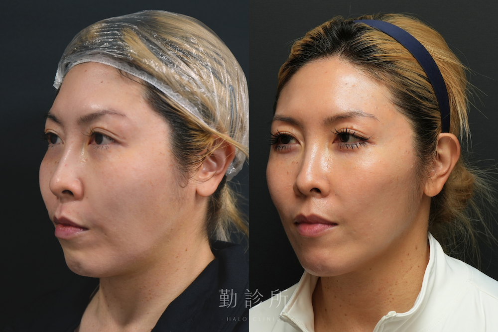 勤診所｜鳳凰電波案例：紫鑽探頭全+碧眼探頭