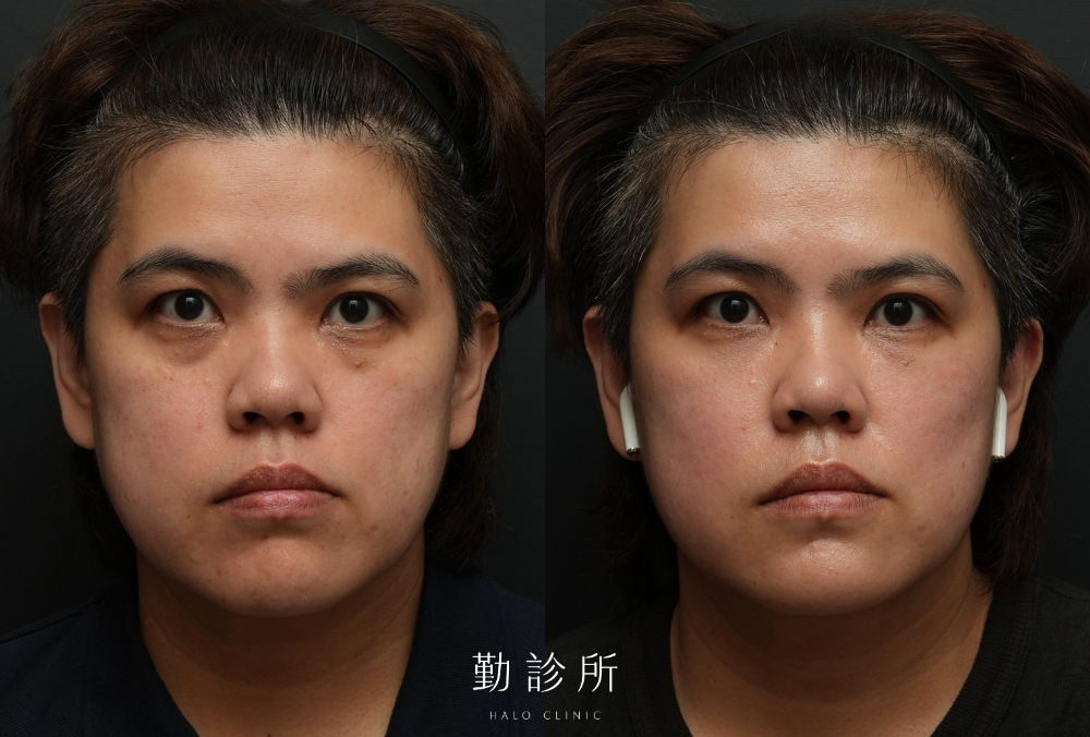 勤診所｜三層式淚溝隱形案例： 正面