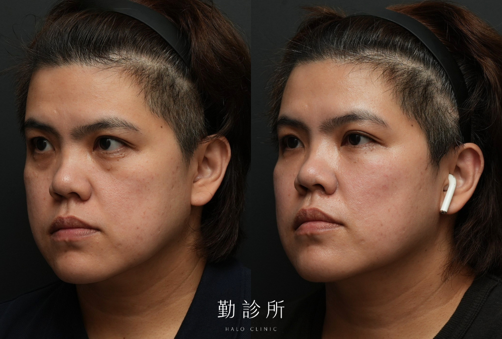 勤診所｜三層式淚溝隱形案例： 左臉
