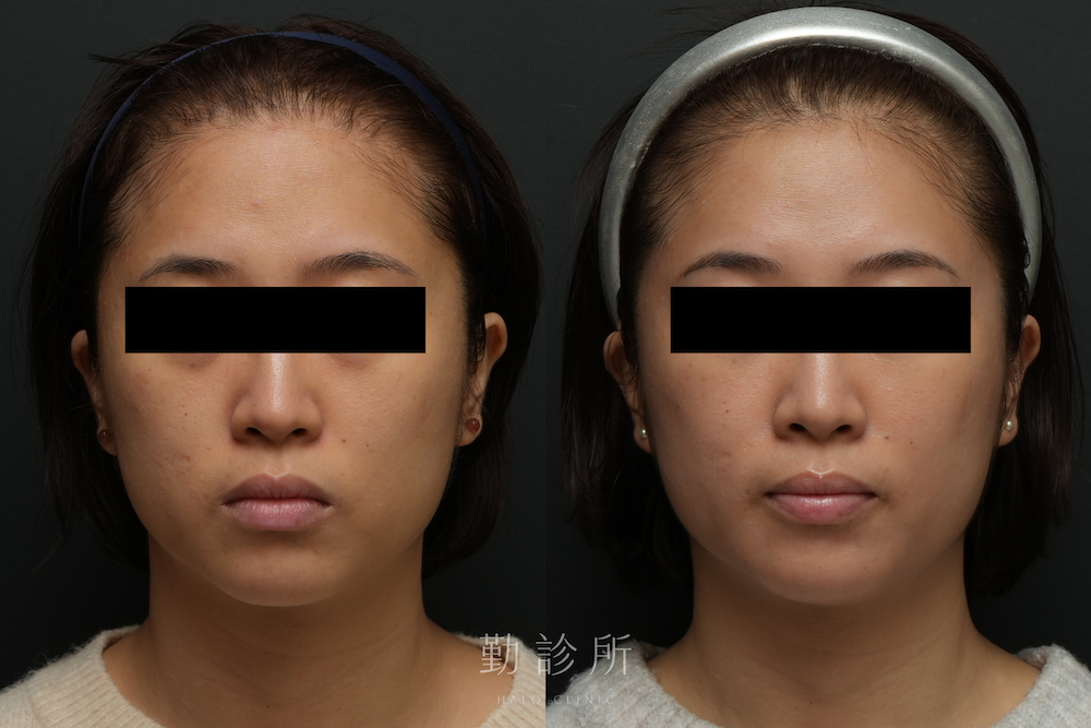 勤診所｜音波拉提真實案例：海芙音波拉提 正面