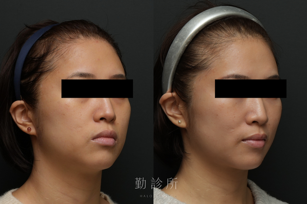 勤診所｜音波拉提真實案例：海芙音波拉提 右臉