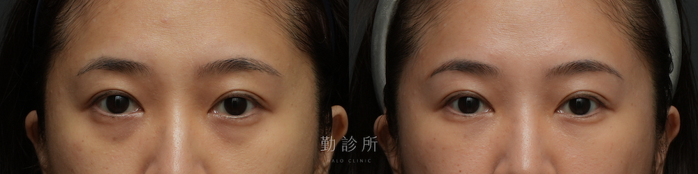 勤診所｜三層式淚溝隱形案例：正面
