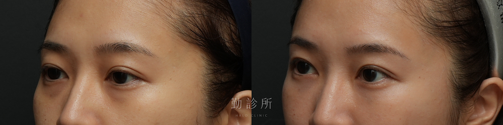 勤診所｜三層式淚溝隱形案例：左臉