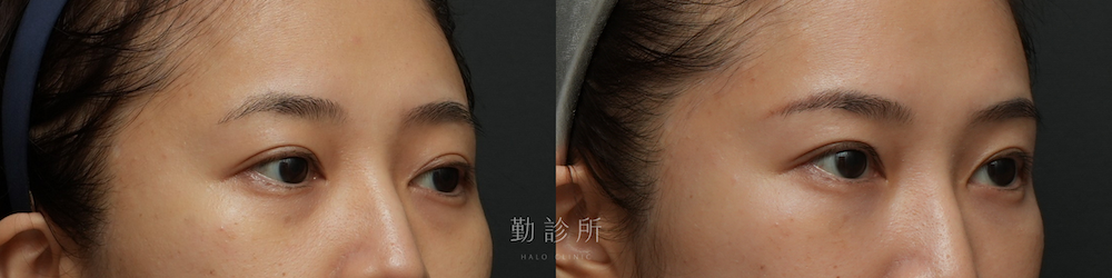 勤診所｜三層式淚溝隱形案例：右臉