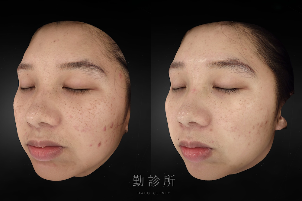 勤診所｜心動光案例：二次治療後 左臉