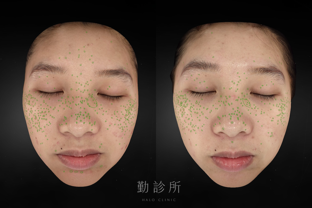 勤診所｜心動光案例：二次治療後 正面