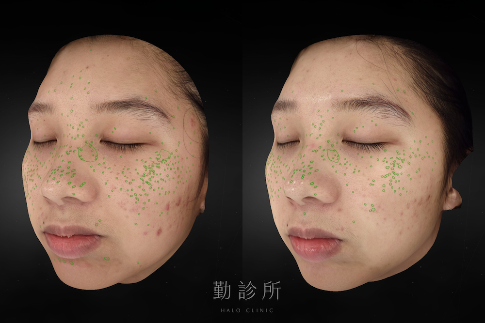 勤診所｜心動光案例：二次治療後 左臉
