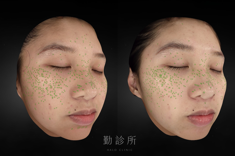 勤診所｜心動光案例：二次治療後 右臉