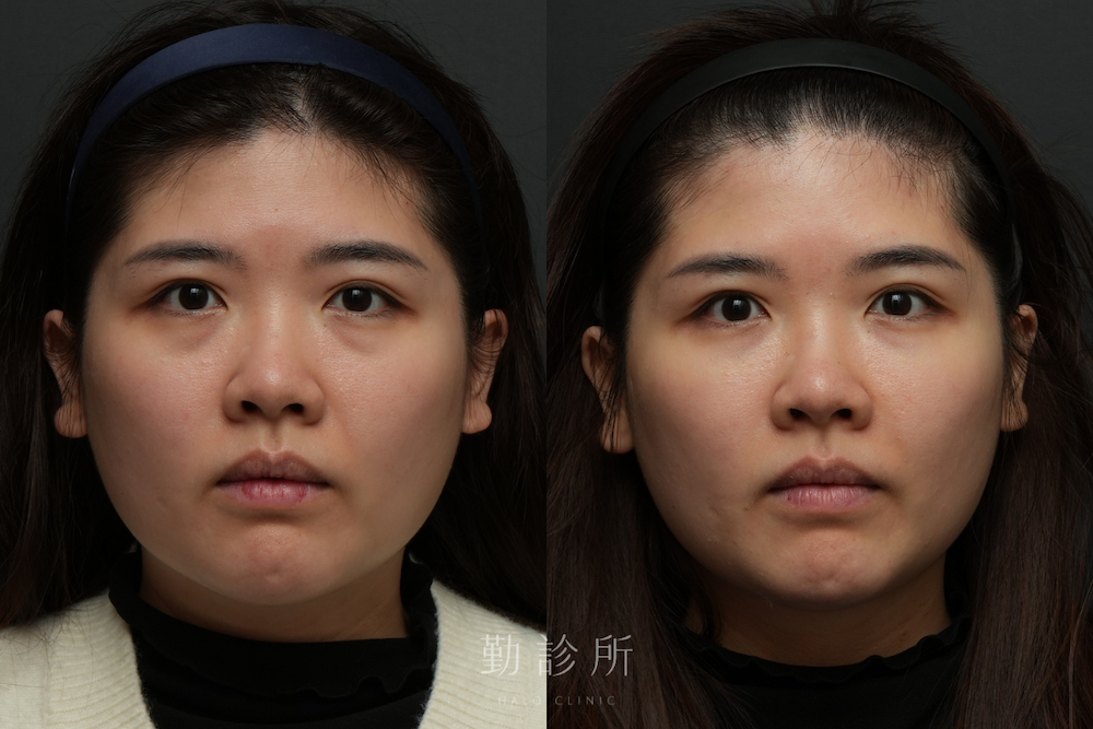 勤診所｜三層式淚溝隱形案例： 正面