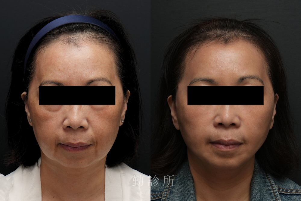 勤診所｜跨層次迴繞拉提案例：全臉組織抬升 正面
