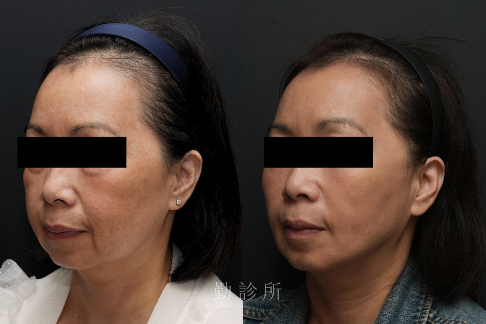 勤診所｜跨層次迴繞拉提案例：全臉組織抬升 左臉