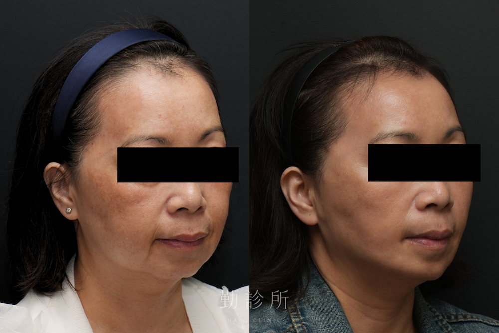勤診所｜跨層次迴繞拉提案例：全臉組織抬升 右臉