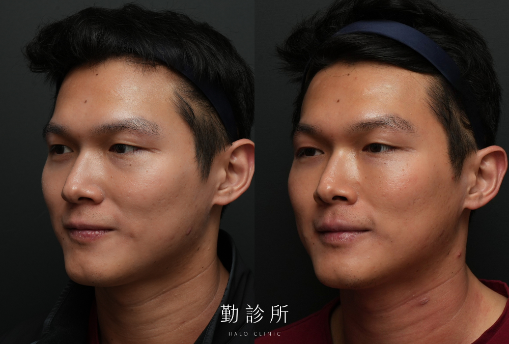 勤診所｜三層式淚溝隱形案例：左臉