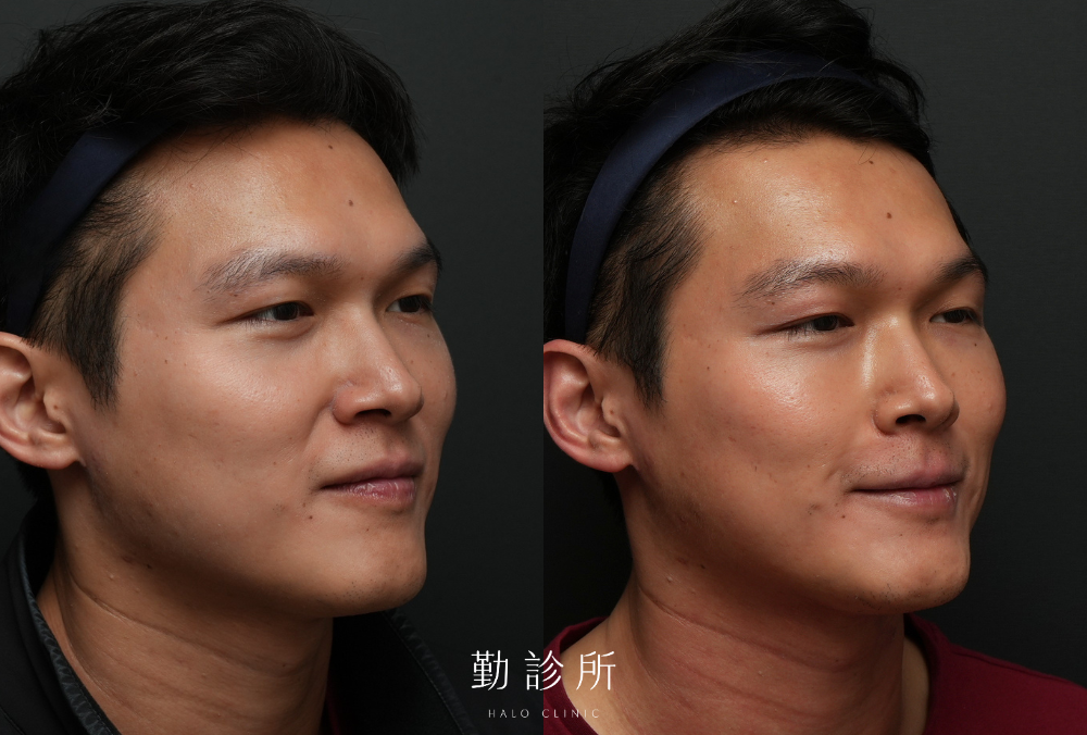勤診所｜三層式淚溝隱形案例：右臉