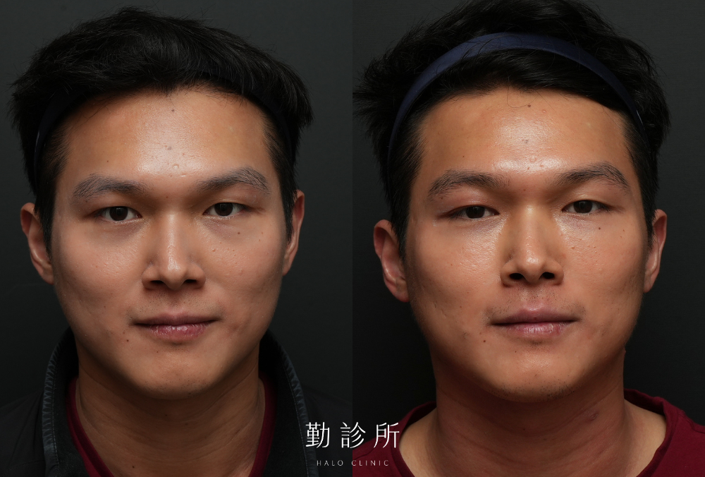 勤診所｜三層式淚溝隱形案例：正面
