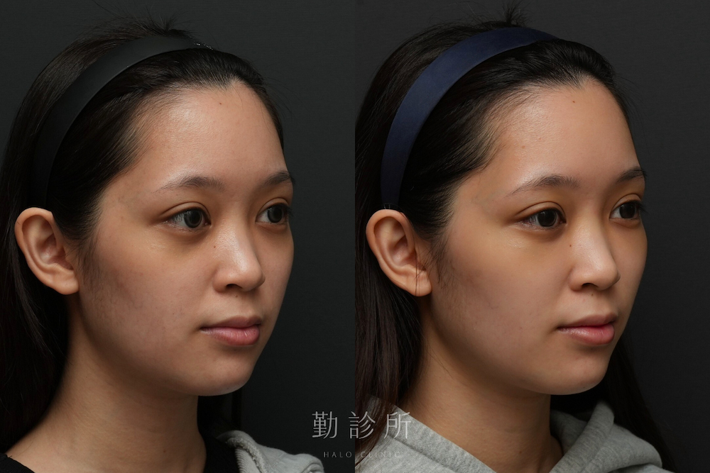 勤診所｜三層式淚溝隱形案例：右臉