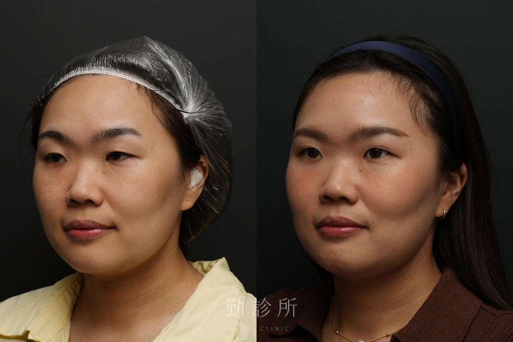 勤診所｜鳳凰電波案例：紫鑽探頭全臉+閃電音波＋肉毒小臉 左臉
