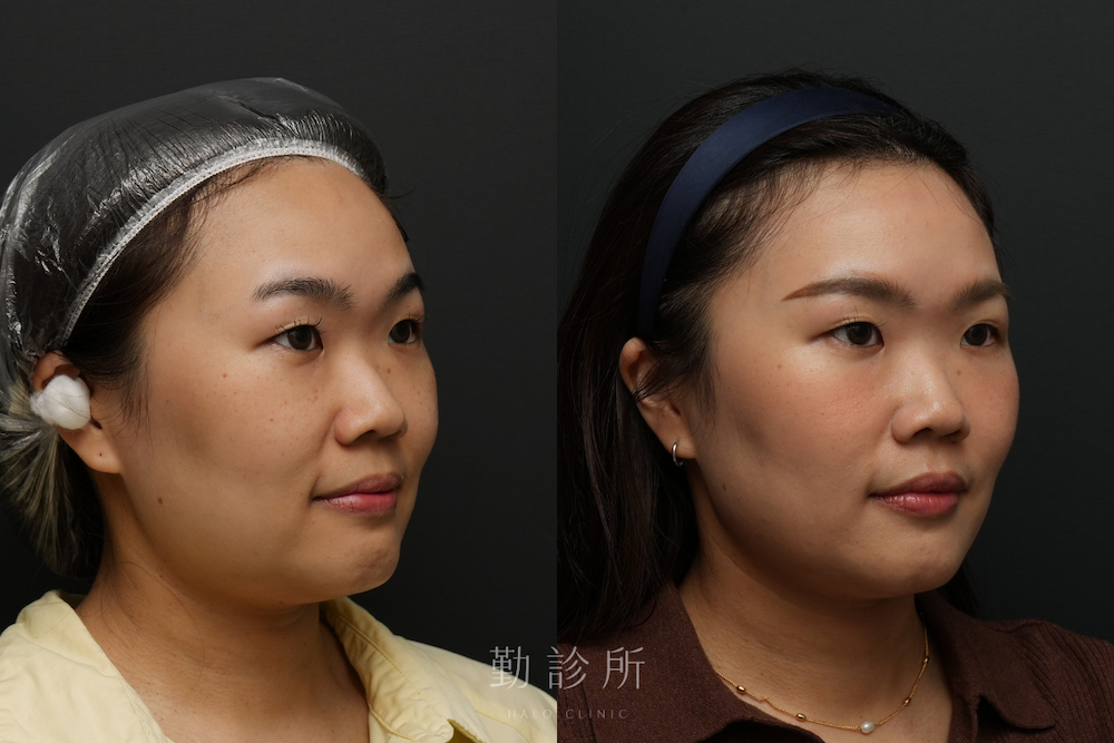 勤診所｜鳳凰電波案例：紫鑽探頭全臉+閃電音波＋肉毒小臉 右臉