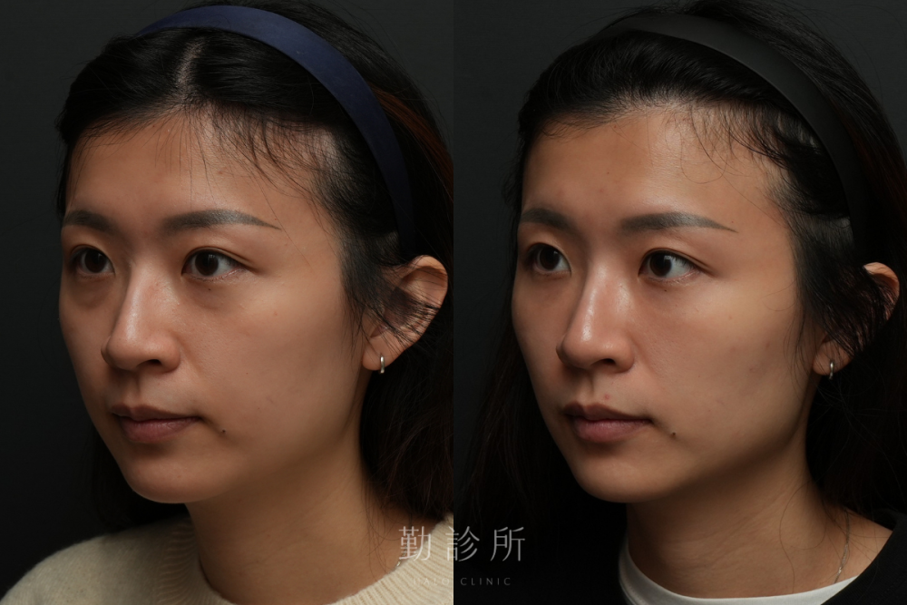 勤診所｜三層式淚溝隱形案例： 左臉