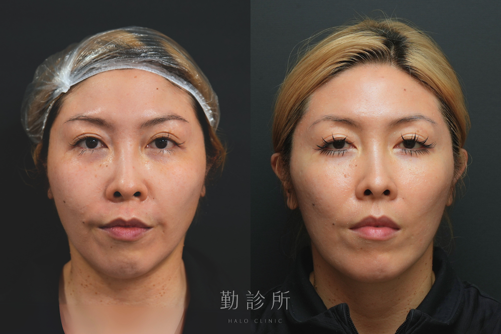 勤診所｜鳳凰電波案例：紫鑽探頭＋緹奧希法令紋 正面