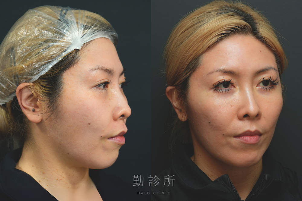 勤診所｜鳳凰電波案例：紫鑽探頭＋緹奧希法令紋 右臉