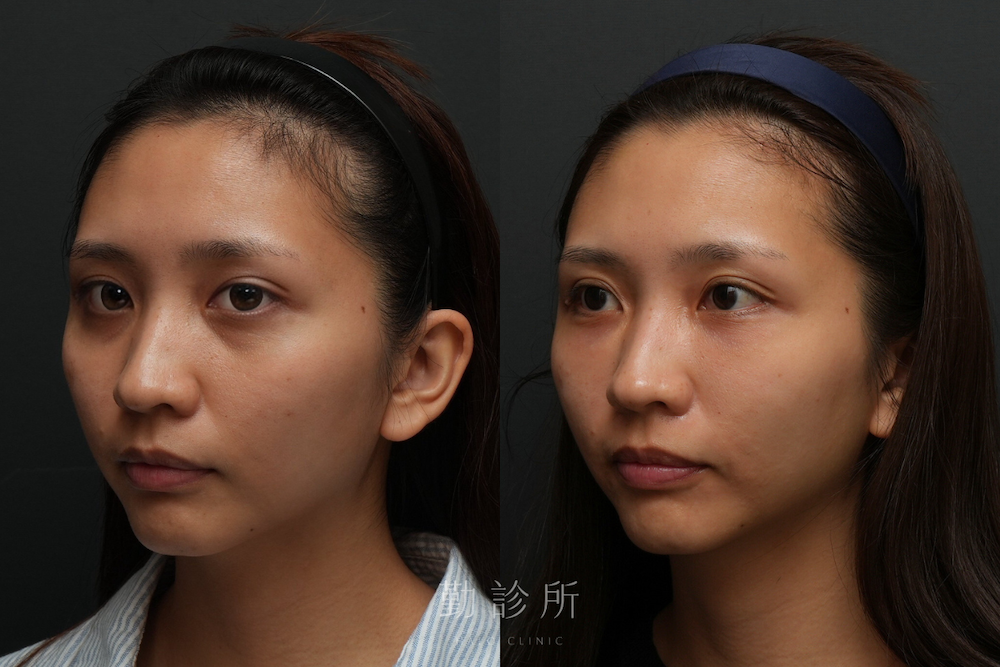 勤診所｜三層式淚溝隱形案例： 左臉
