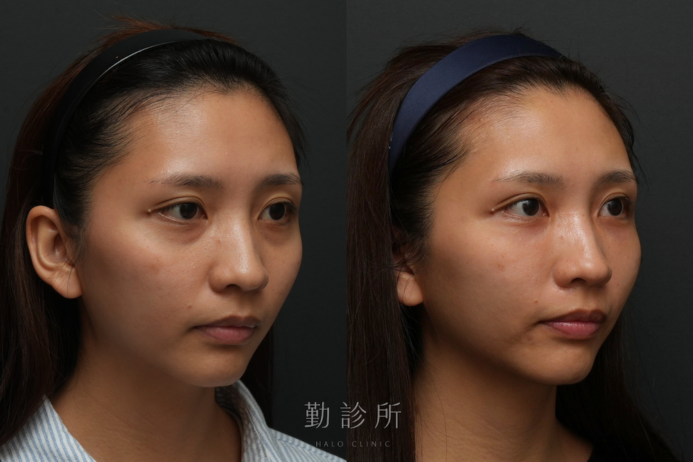 勤診所｜三層式淚溝隱形案例： 右臉